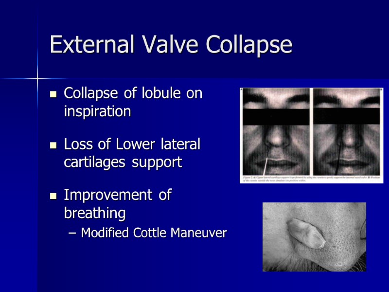 >External Valve Collapse  Collapse of lobule on inspiration  Loss of Lower lateral